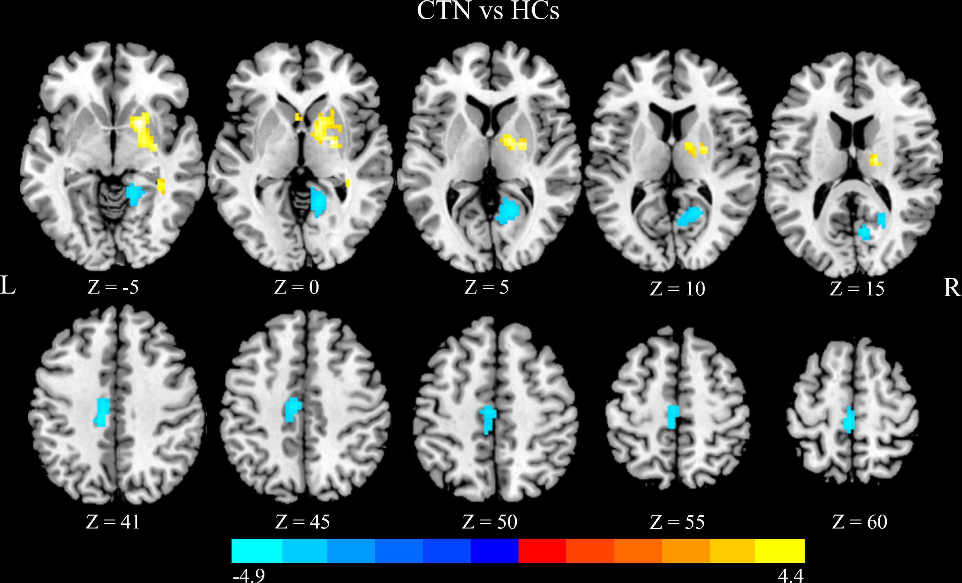Alterations of degree centrality and functional connectivity in classic trigeminal neuralgia